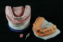 Meistermodell mit Zahnfleischmaske